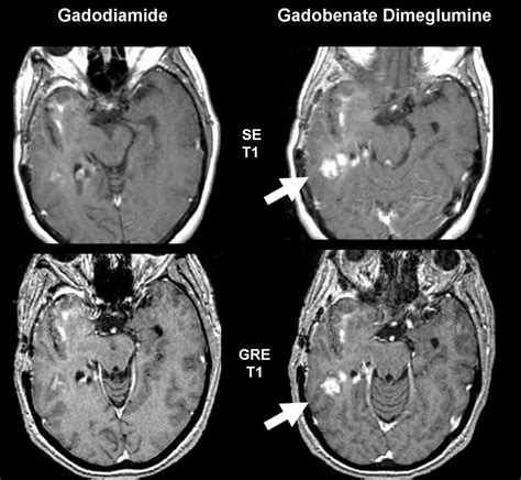 the villages brain mri with contrast|Brain MRI: How to read MRI brain scan .